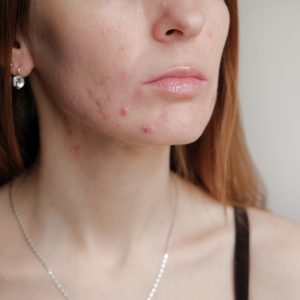 Máscara facial e espinhas: dermatologista explica a relação